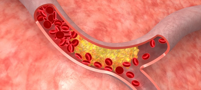 Testosterone Therapy Increases Artery Plaque Build Up Which Can Cause A Heart Attack