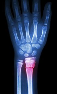 Magnesium and D3 reduce the risk of bone fractures