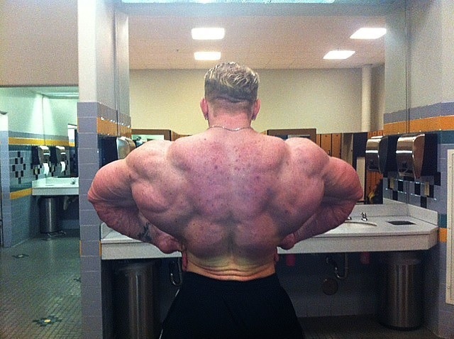 steroid user with back acne 