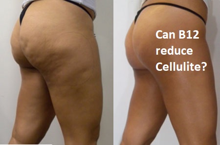 vITAMIN b12 CAN REDUCE CELLULITE. picture OF A LADY WITH CELLULITE